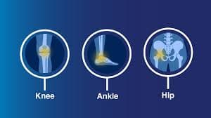 Exactech Joint Replacement